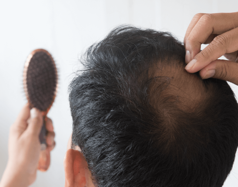 為什麼雄性禿掉髮的區域主要在頭頂呢？