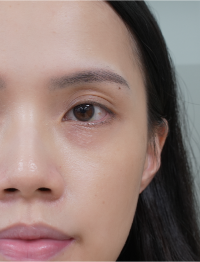 skin_test_Kerry