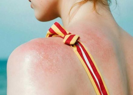 曬傷怎麼辦？教你處理曬傷脫皮三步驟，讓你的肌膚重回白皙透亮