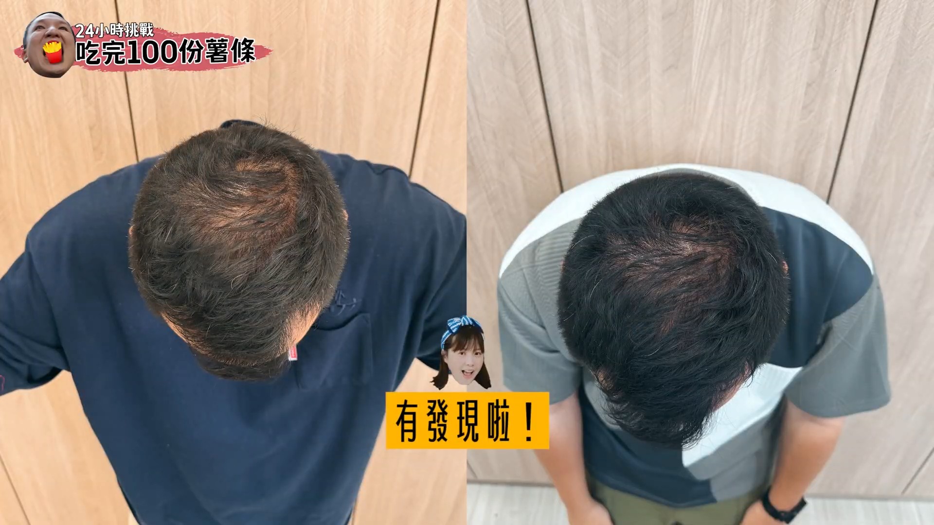 蔡宗翰使用iRESTORE雷射生髮帽6個月對比圖