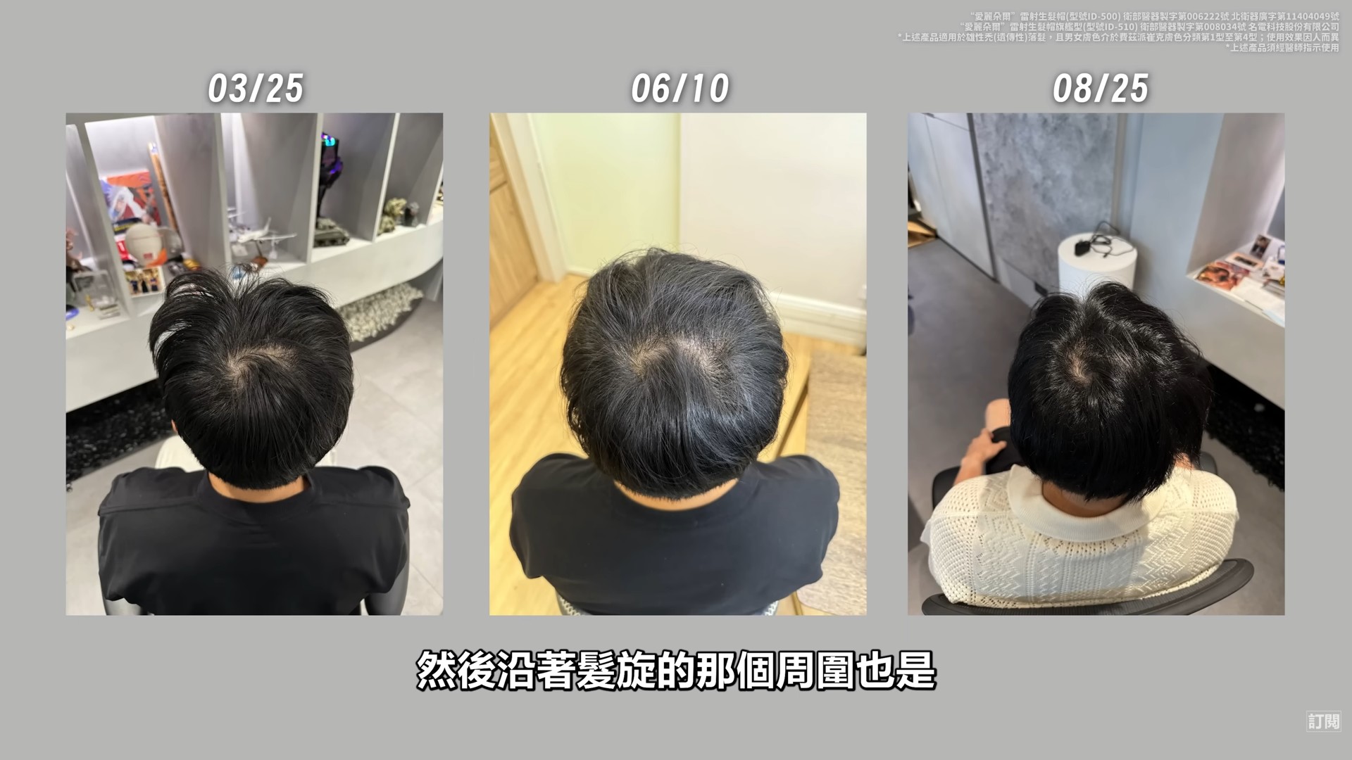 Joeman使用生髮帽5個月前後對比