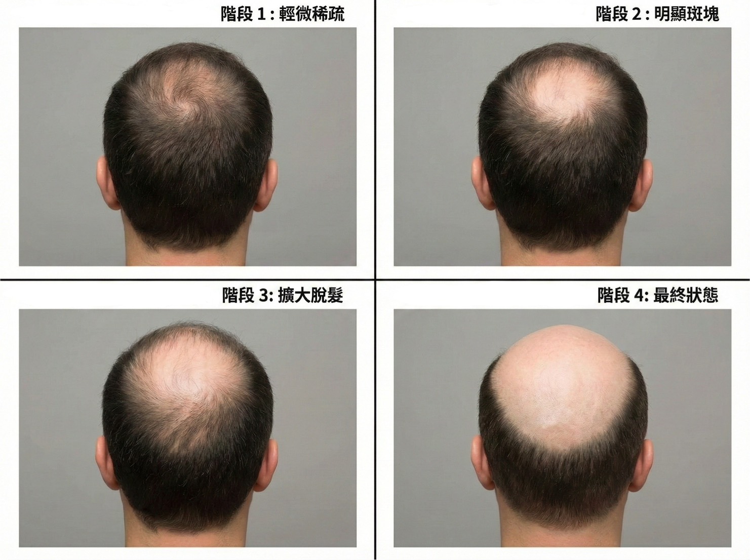 O型禿的演變過程