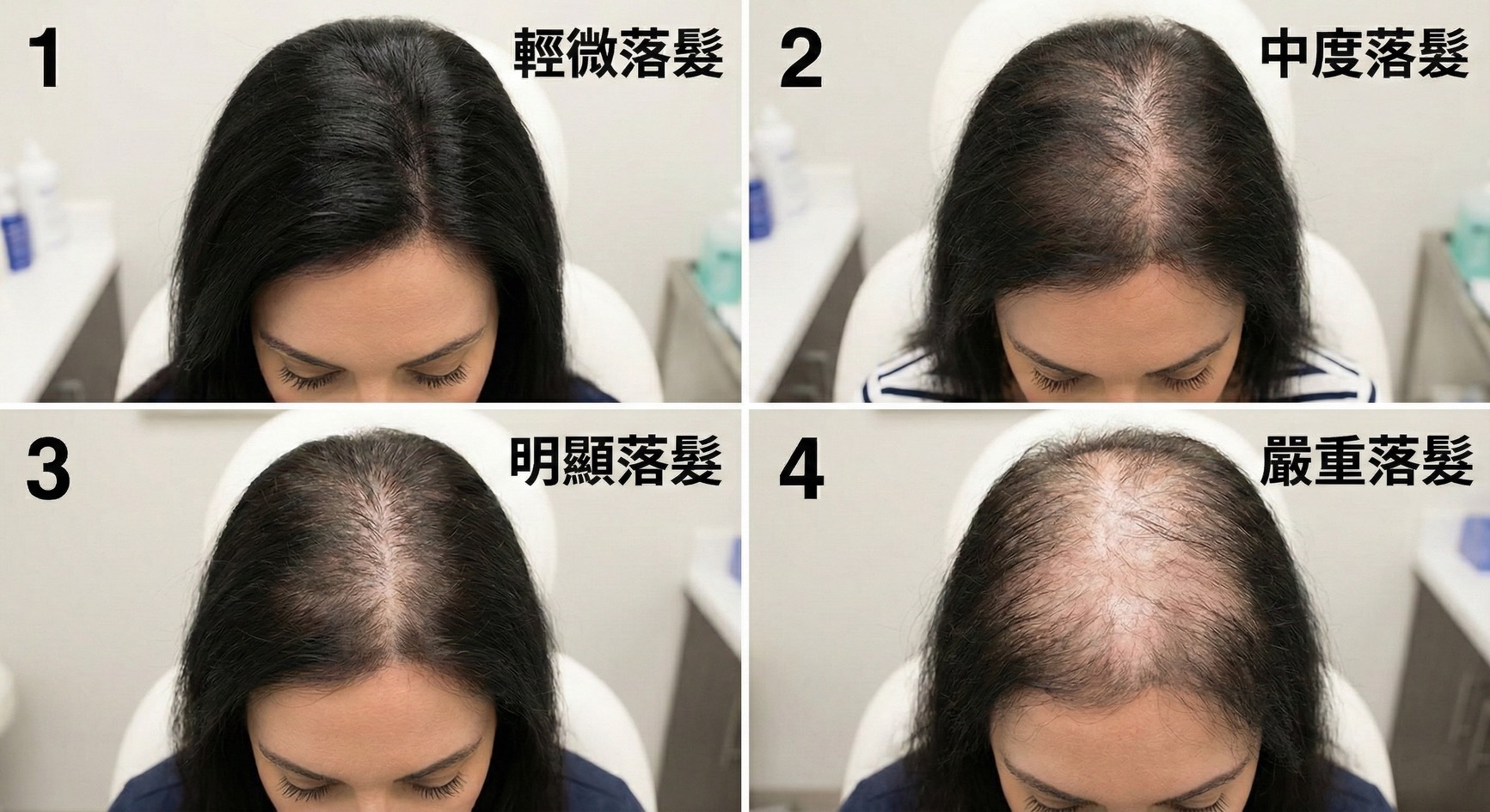 廣泛型落髮的演變過程