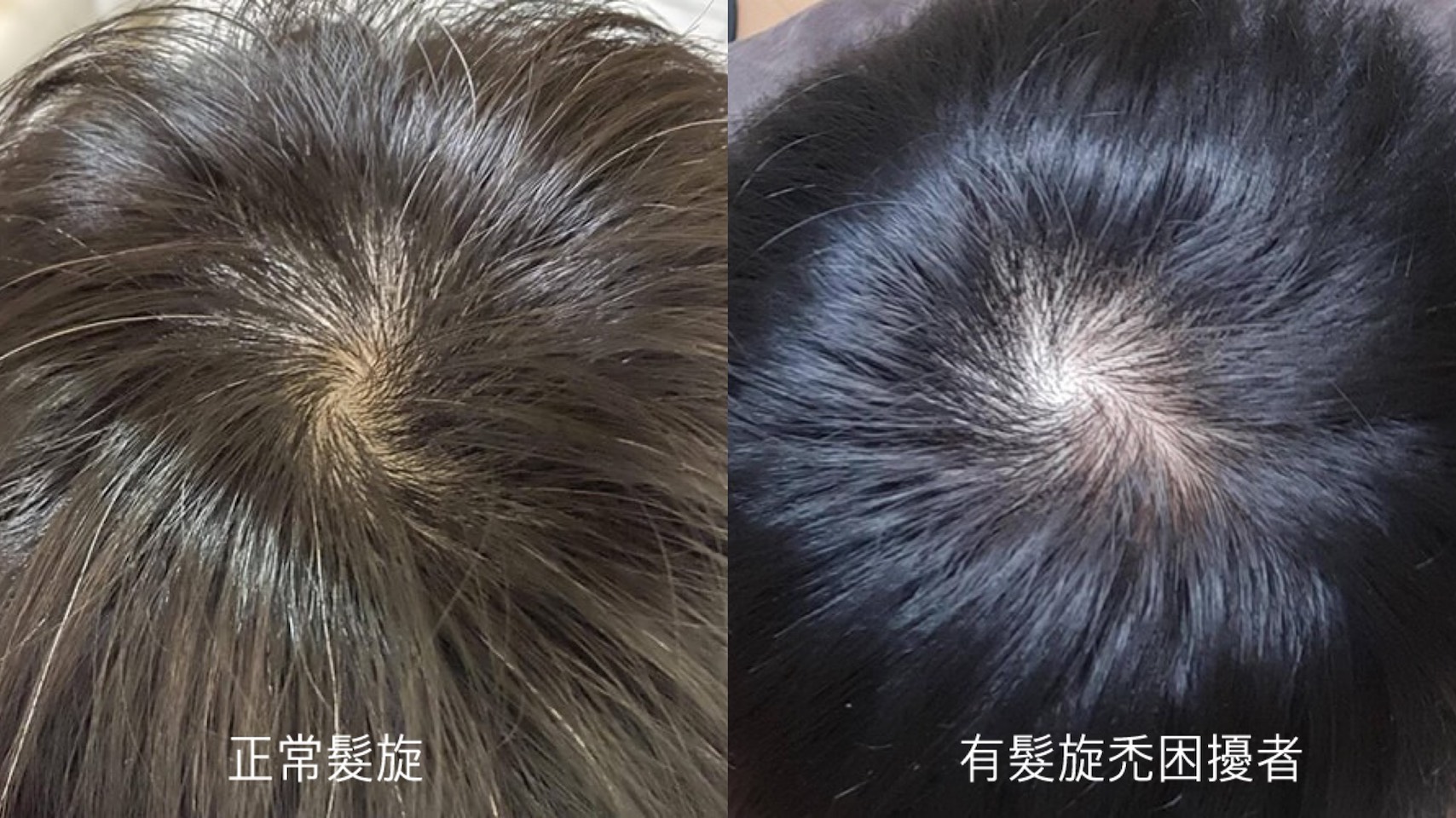 髮旋禿